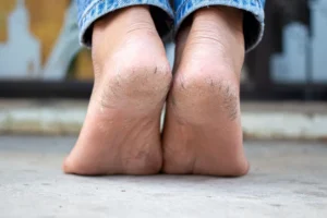 Bliža se poletje, vi pa imate suhe in razpokane pete?