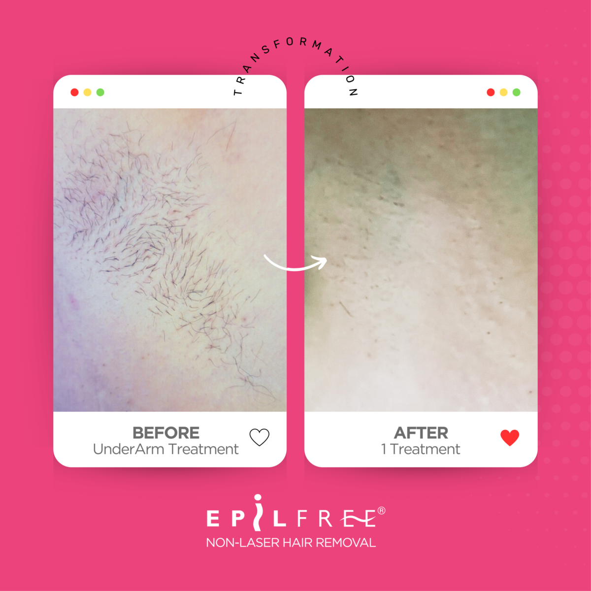 EPILFREE PROFESIONALNI SET ZA REDUKCIJO DLAK – INTIM CARE - slika 6