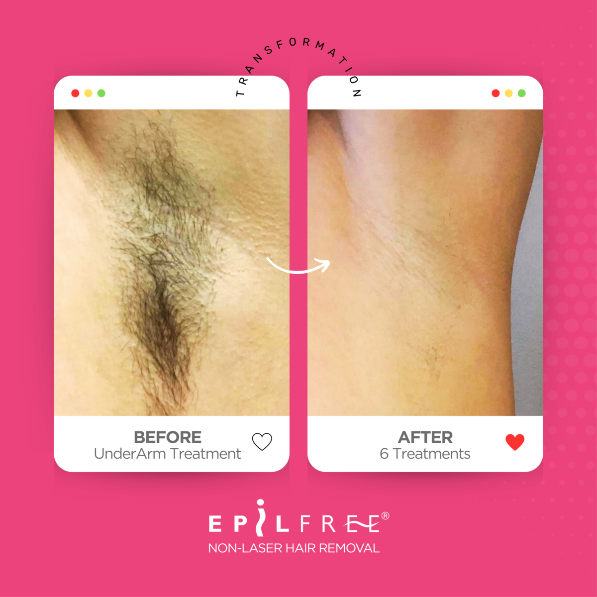 EPILFREE PROFESIONALNI SET ZA REDUKCIJO DLAK – INTIM CARE - slika 5