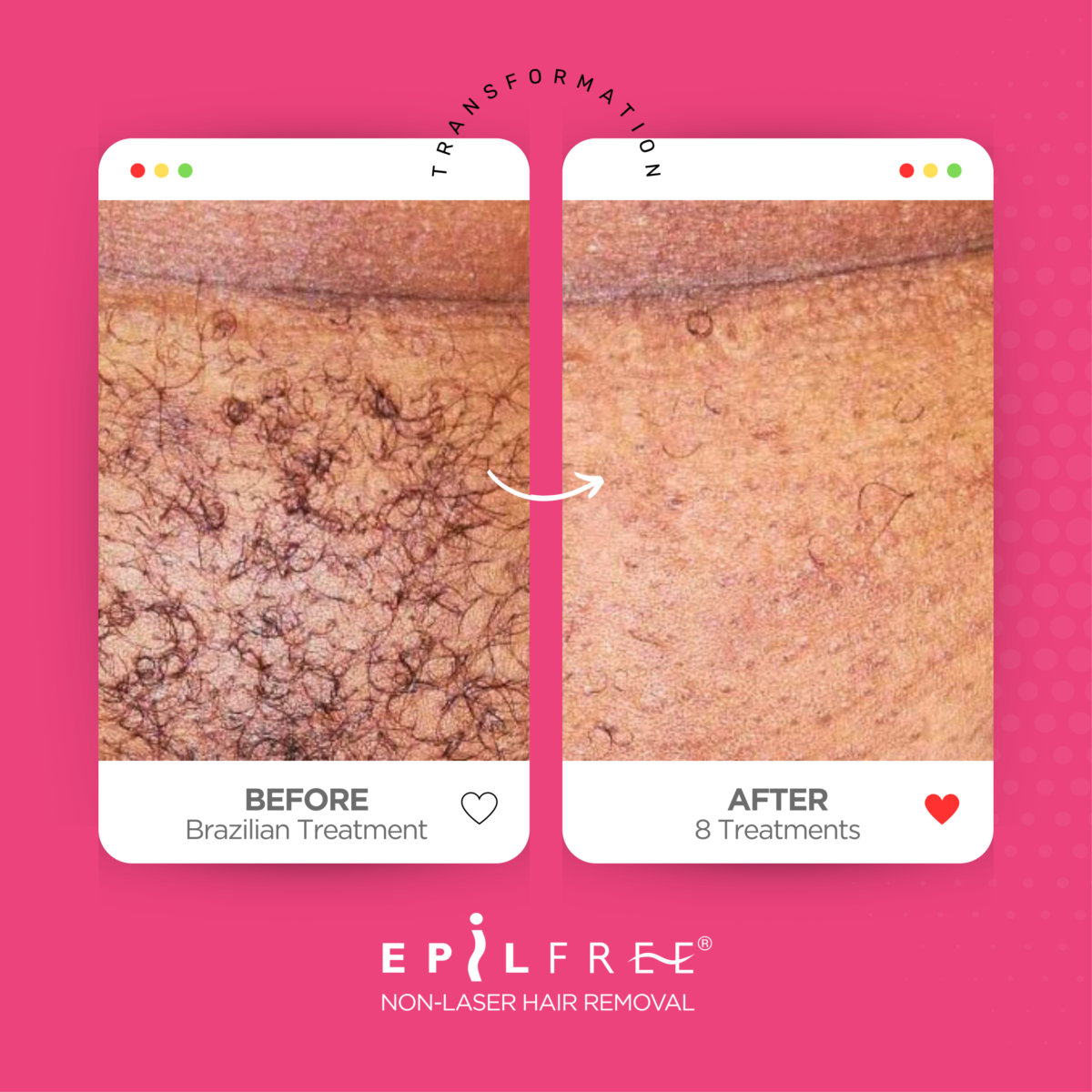 EPILFREE PROFESIONALNI SET ZA REDUKCIJO DLAK – INTIM CARE - slika 4