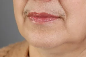 Hirzutizem ni redkost. In rešitve ne bi smele biti boleče
