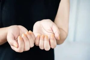 Zakaj se pojavijo rumeni nohti na nogah ali rokah?