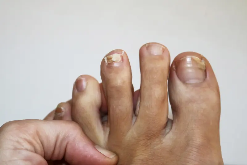 Kako sanirati odstopanje nohta in spodbuditi rast novega?