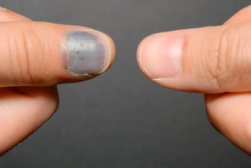 Počrneli nohti na nogah ali rokah