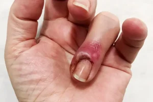 Ali vnetje okrog nohtov (onihitis) vodi do odstopanja nohta?