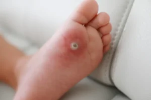 Kako odstraniti kurje oko (otiščanec) in zakaj se ponavlja?